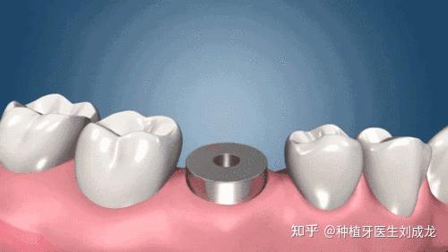郑州种植牙医生刘成龙:磨牙区单颗种植案例