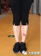 如果髋膝踝内旋o形腿是加重了;如果外旋则o形腿改善变直了.