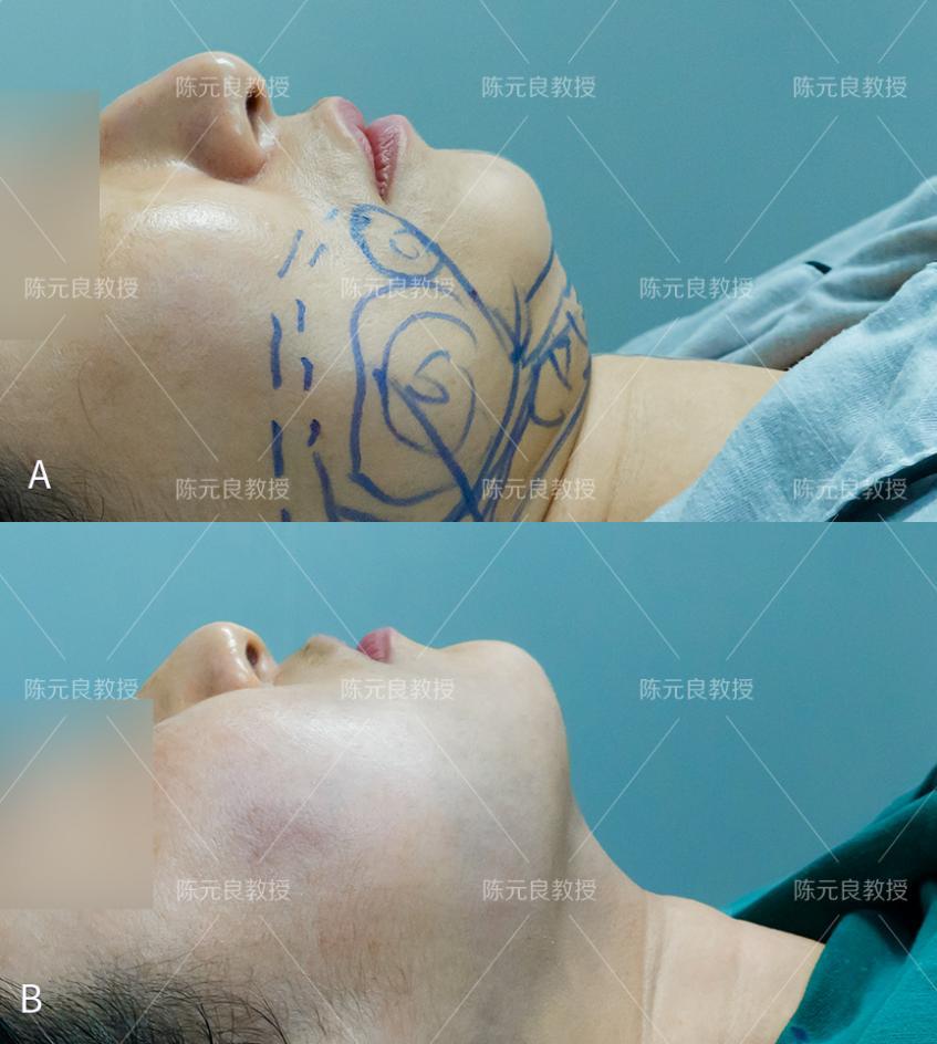 做完双下巴维密脂雕口角囊袋光纤溶脂至少年轻5岁