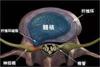 为什么腰椎间盘膨出却痛的比腰椎间盘突出更厉害?原因