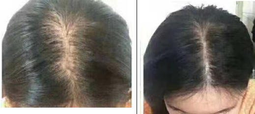 有谁治好了脂溢性脱发女性脂溢性脱发多久能治好