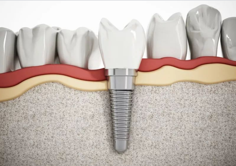 牙被誉为"人类的第三副义齿",通过人工种植的方式来修复缺失的牙齿