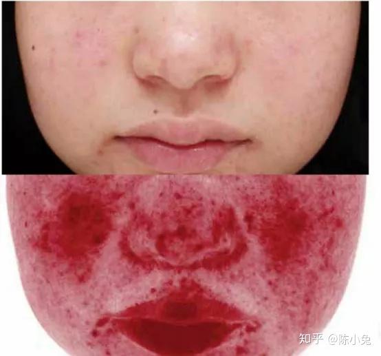 血清渗出使组织间发生水肿,挤压皮下组织向表皮外凸起,形成橘皮样