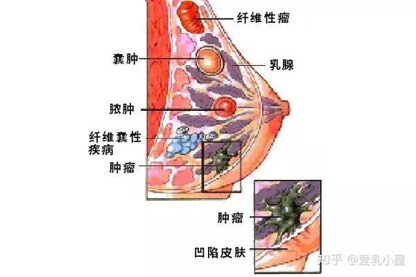 不少女性自我乳房检查的时候,容易摸到一块一块的硬块.