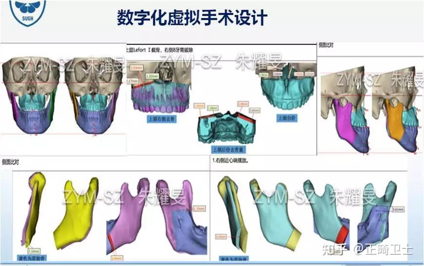 朱耀旻博士数字化正颌手术案例分享