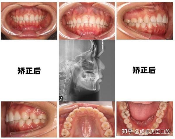 25,磨牙6舌面粘接nance托支抗,上下颌自锁固定矫治器.