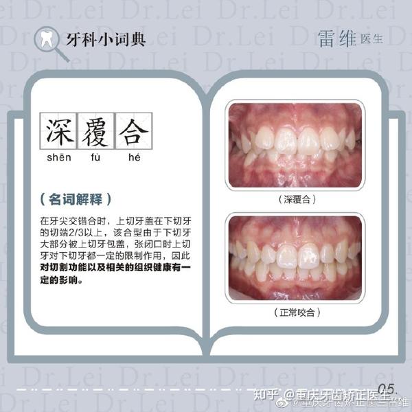 重庆牙齿矫正案例深覆颌深覆盖