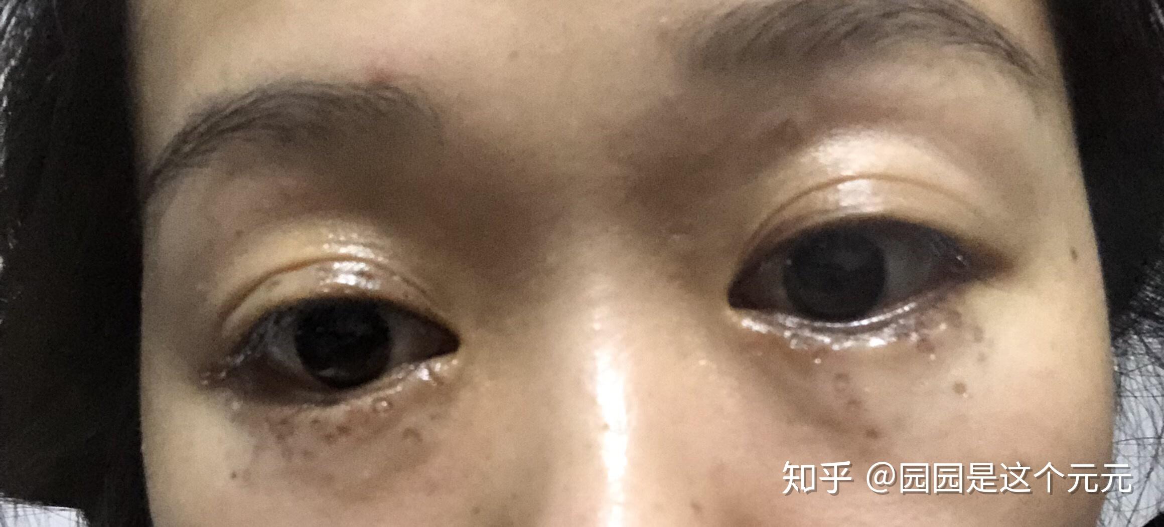 我眼周汗管瘤的治疗之路71