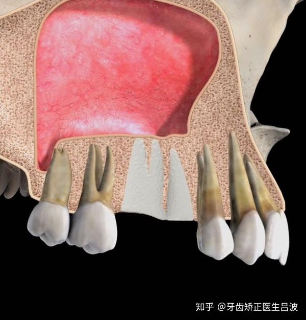 什么是上颌窦囊肿