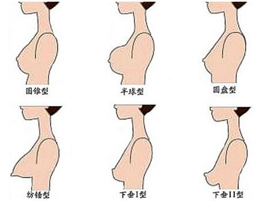 隆胸方式/乳房矫正全介绍(上)|揭开美胸的神秘面纱