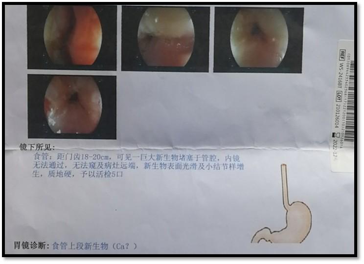 胃恶性肿瘤诊疗【关键词:全胃切除术后,新发食管病灶