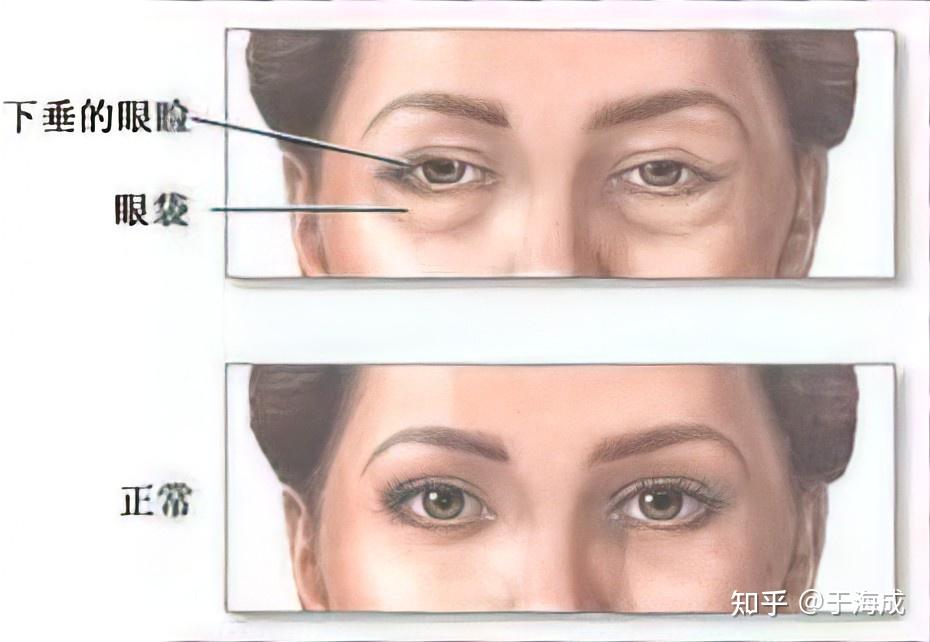 哪些行为会导致上眼皮松弛