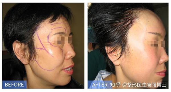 切口筋膜悬吊(拉皮手术) 根据客人的松垂程度,在脸上设计3-5个悬吊点