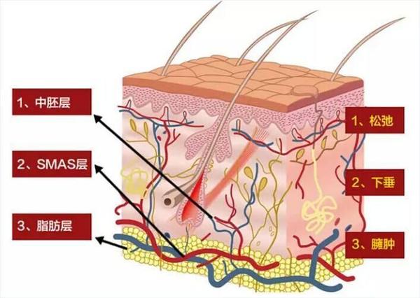 深入皮肤smas层(筋膜层),增强肌底弹力纤维