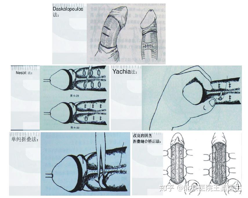 男性阴茎弯曲畸形及临床诊断治疗精华帖
