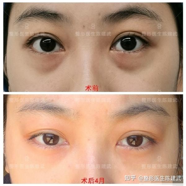 28岁眼袋女生笑起来特别显老术后4个月变化喜人