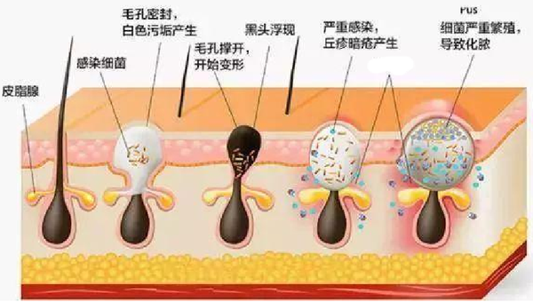 粉刺分为黑头和白头