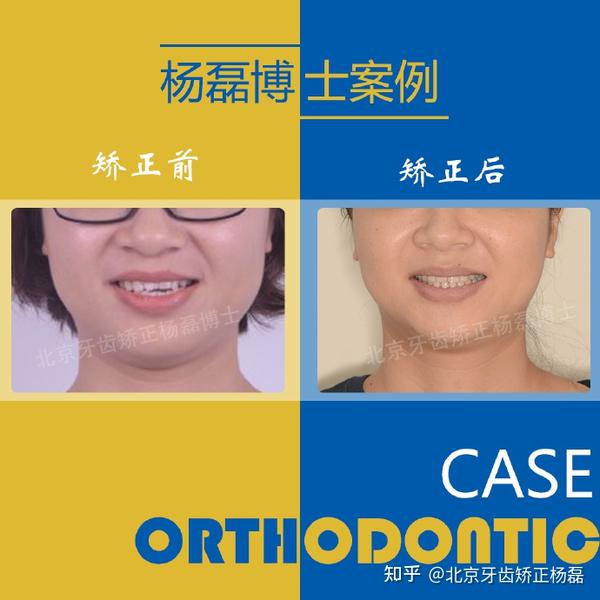 北京牙齿矫正杨磊:「偏颌反颌案例」
