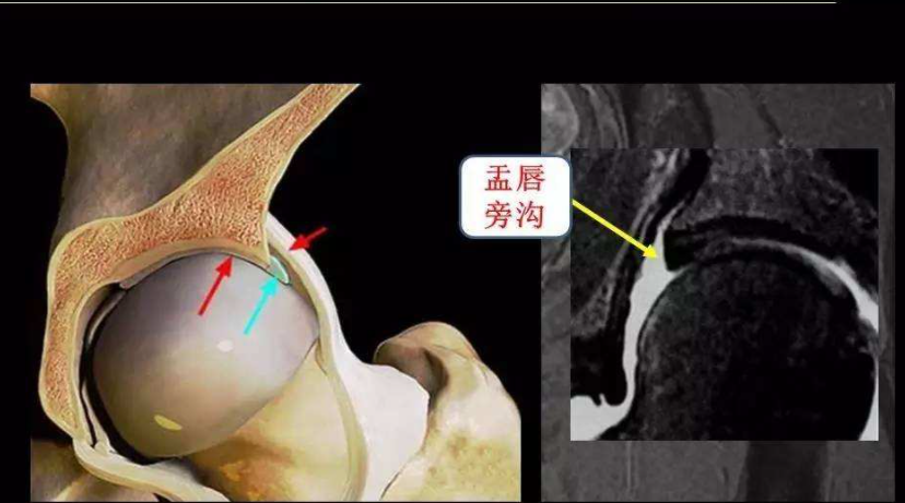 髋臼盂唇损伤的病变特点和诊断