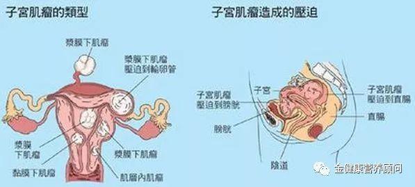 我有子宫肌瘤会不会癌变我想切掉