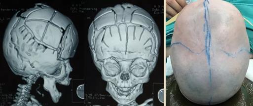 神经外科主任医师 1 人 赞同了该文章 1,颅缝早闭的诊断标准是什么?