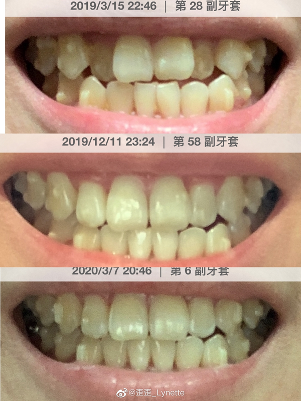 历时一年的牙齿矫正前后对比照片