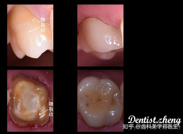 牙齿隐裂的问题