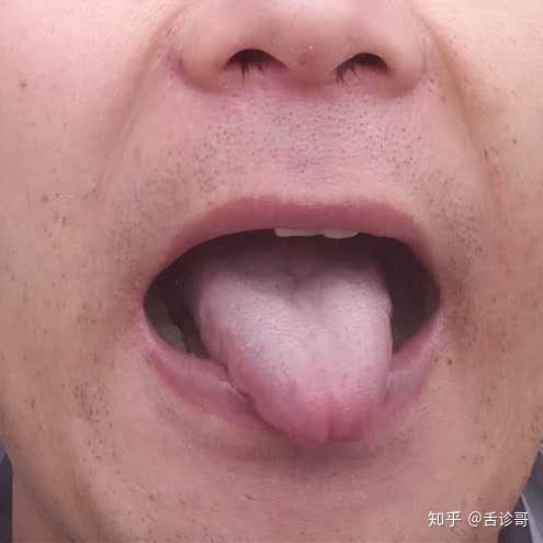 抖音舌诊哥:舌诊知健康,教你学会看舌象系列二十