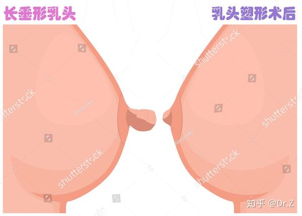 哺乳后乳房衰老三联征之乳头肥大乳头缩小术