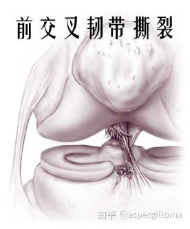 前交叉韧带撕裂了该怎么办