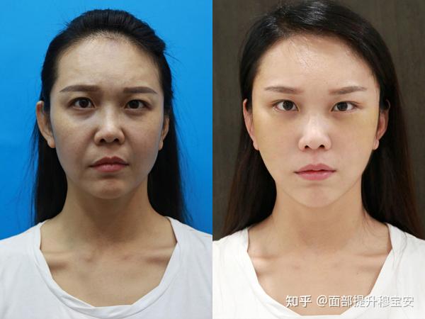 从医学视角谈谈拉皮手术修复率为何如此之高?