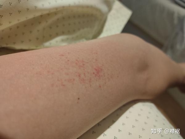 胳膊内侧的小红点是什么
