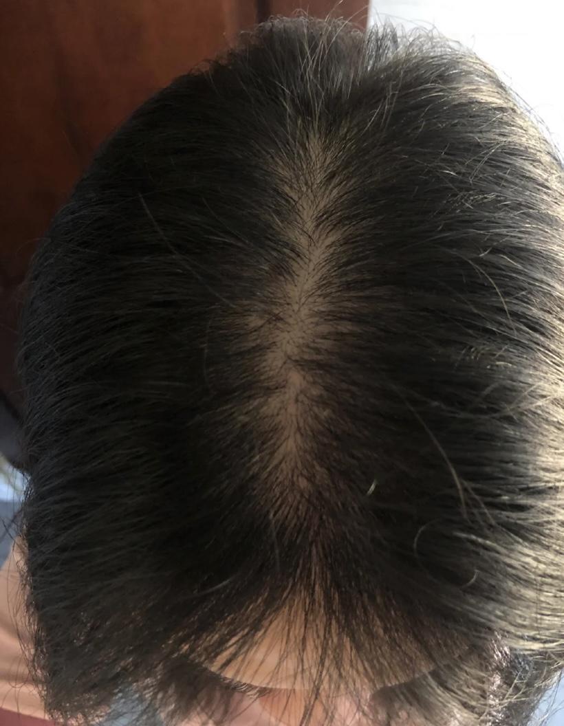 头顶上头发稀疏怎么办