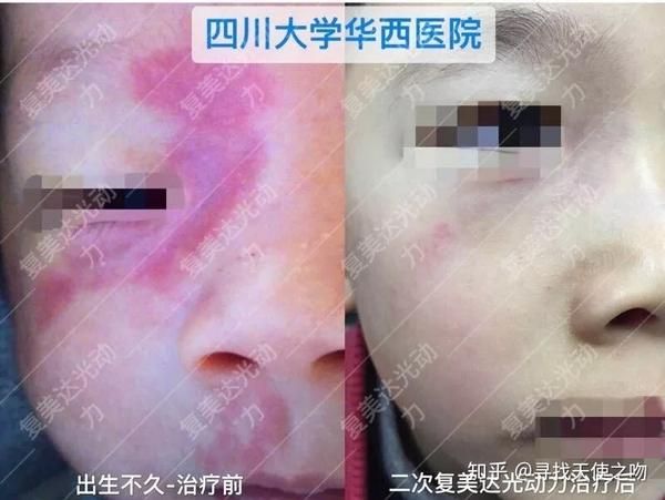 与激光相比, 复美达光动力可以用于绝大多数部位鲜红斑痣的治疗.