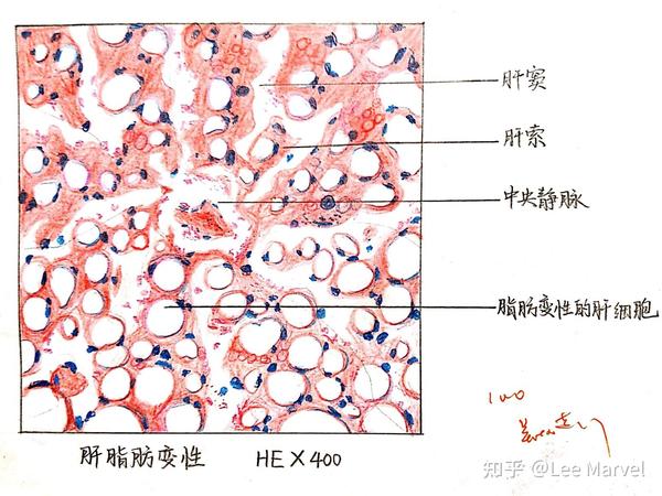 肝脂肪变性 答主现在已经大三啦,正在继续学习病理学,所以后续会持续