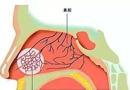 清鼻堂科普鼻子为什么会不通气是鼻炎导致的吗