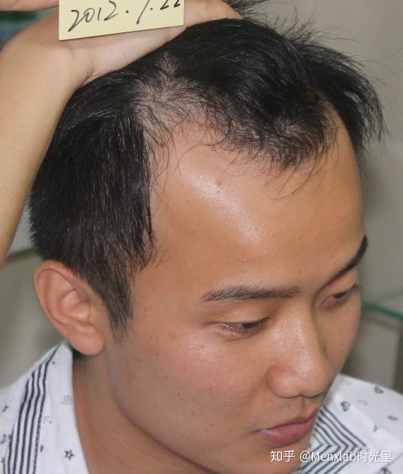 为什么说m型脱发比o型脱发更难治疗