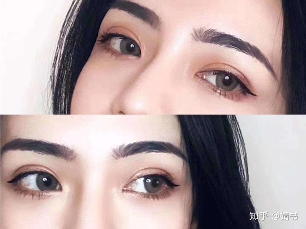 双眼皮手术成功标准