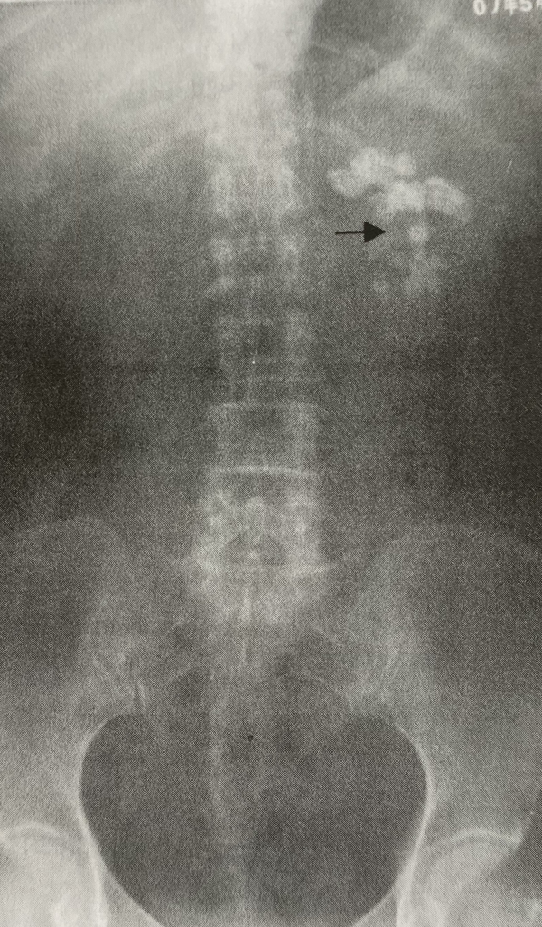 普通x光平片往往用于结石术后复查或者查看输尿管导管的位置