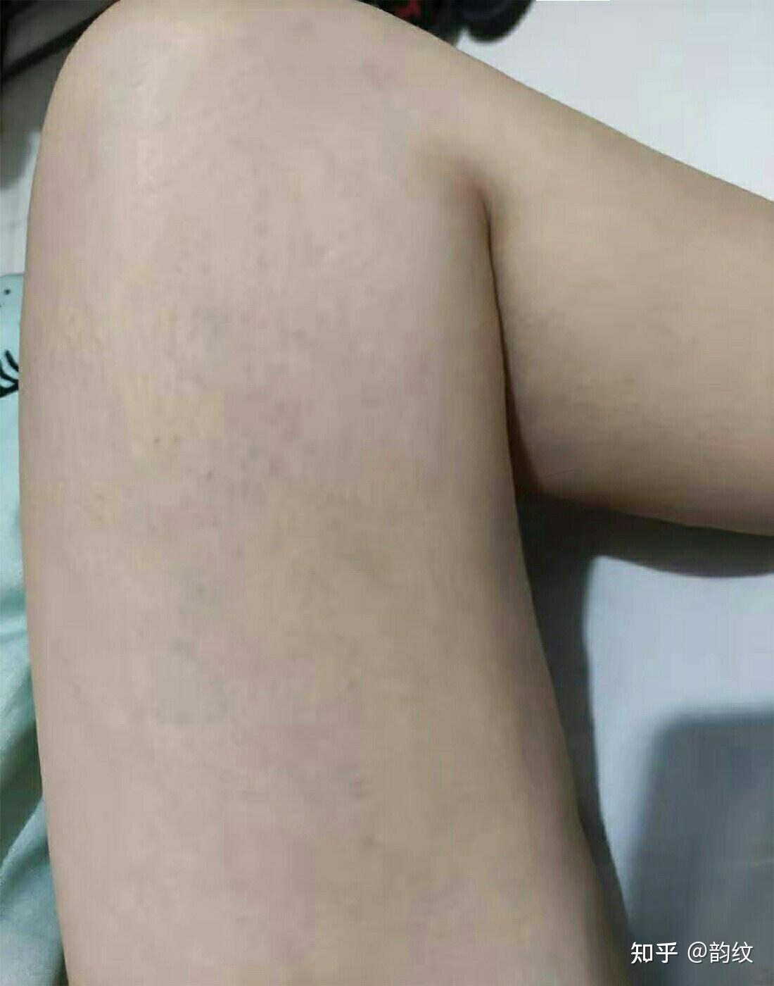 生长纹肥胖纹究竟是怎回事