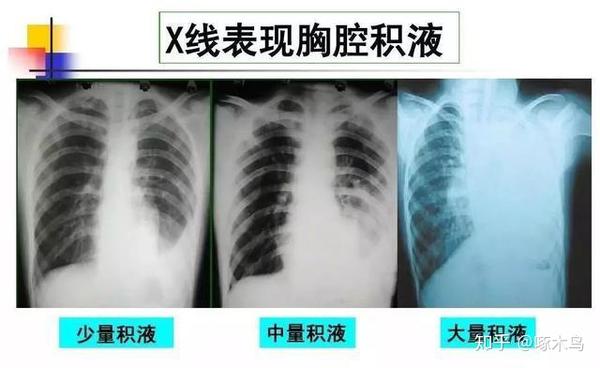 肺癌晚期胸水很"凶",如何应对?