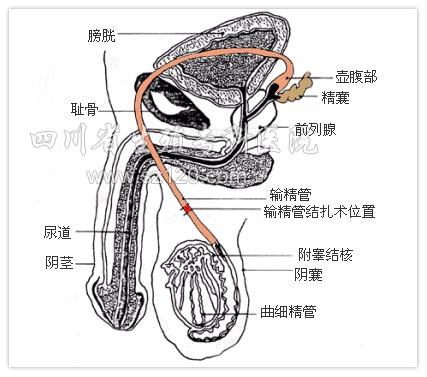 经皮附睾精子抽吸术取精方式