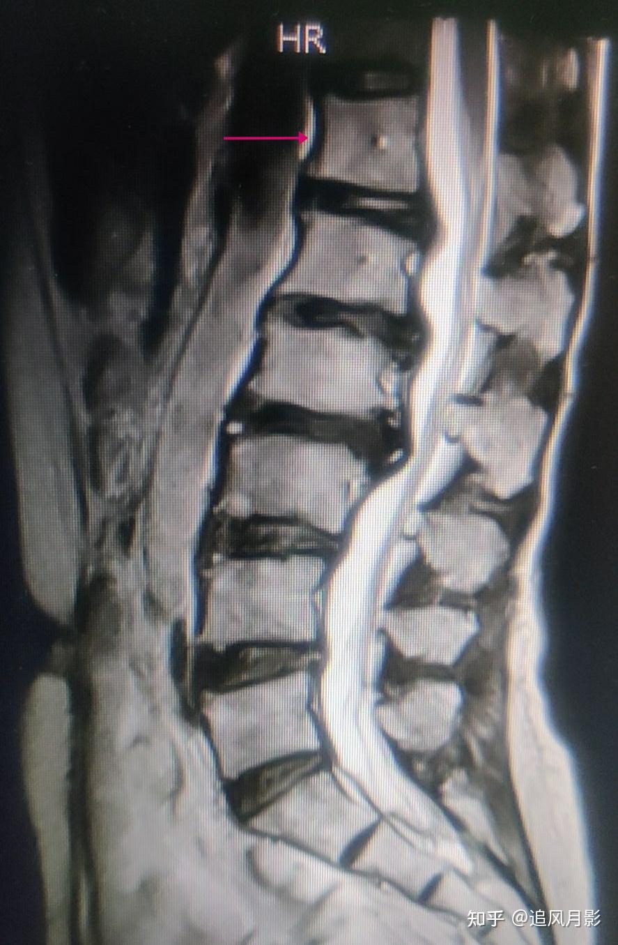 查体,整个胸腰椎棘上没有压痛及叩击痛,前屈,后伸均受限,棘旁肌群紧张