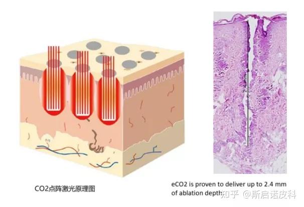 co2点阵激光:战痘计划 毛孔粗大,重塑靓丽肌肤!