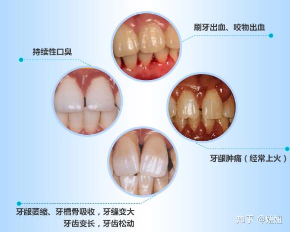 牙周炎四个发展阶段的症状及治疗方法