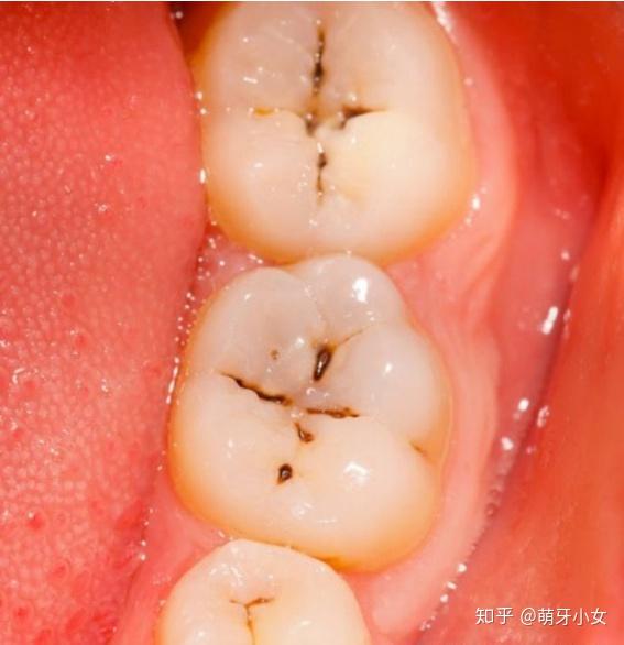 蛀牙从形成到失去牙齿要多久?