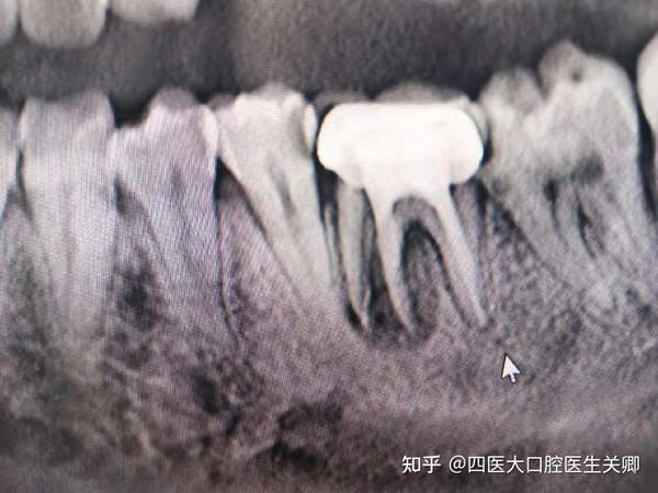 问题1:关老师,这个是牙根吸收还是纵裂?