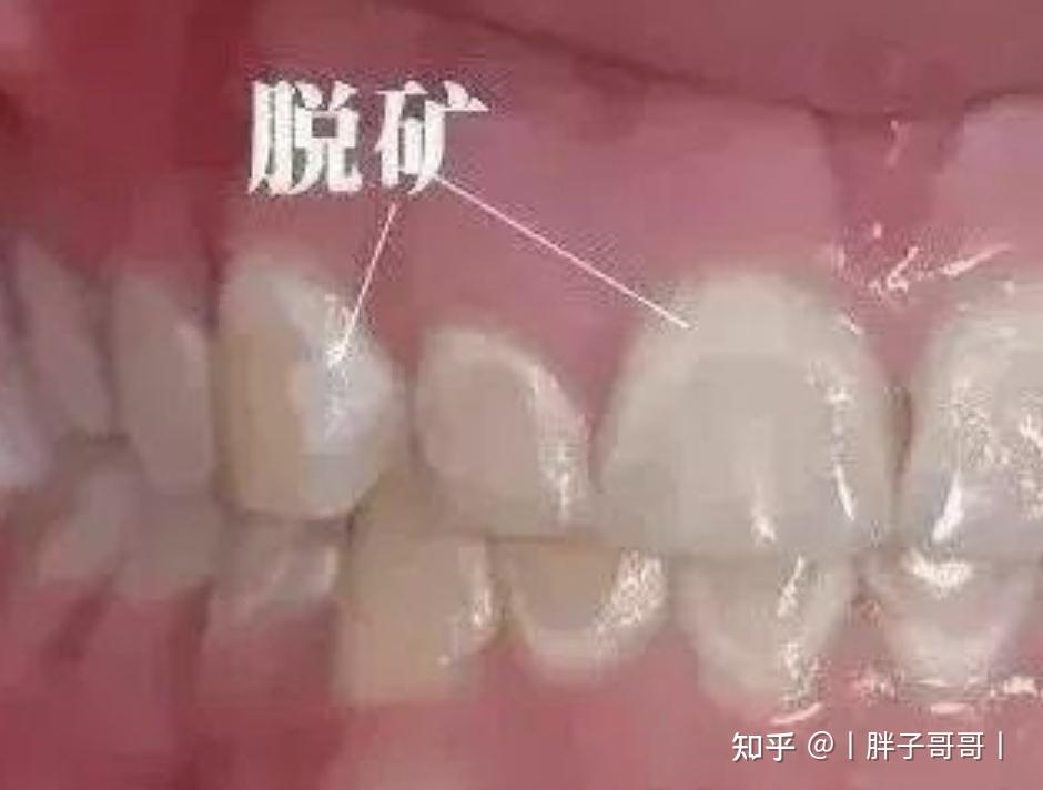为什么牙齿上会有白色的痕迹