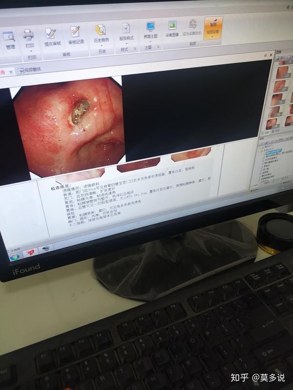 胃溃疡做胃镜,让进一步活检.麻烦问下个各位很严重吗?