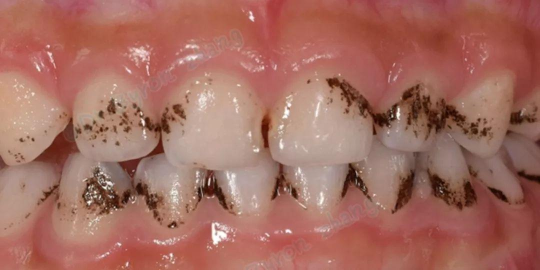 小朋友牙齿上的黑色素能去掉吗?